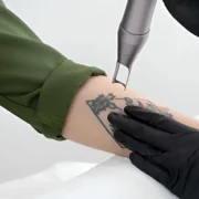 Laser Tattoo Removal