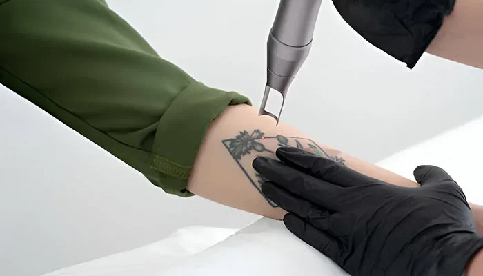 Laser Tattoo Removal