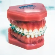 Teeth Braces