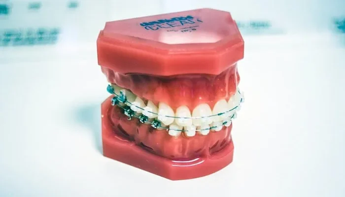 Teeth Braces